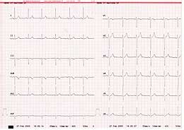 EKG