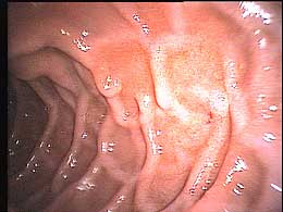 12Fingerdarm-(Duodenum)