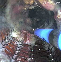 Eröffnung-des-Ösophagusstent