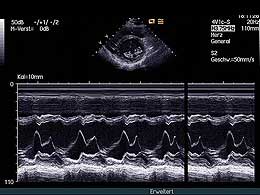 kurze-Achse-M-Mode-Mitralklappe