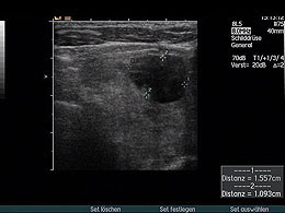 Schilddrüsenknoten-Durchblutung