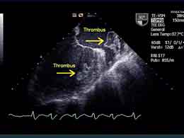 Thrombus