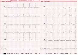 EKG