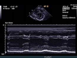 kurze-Achse-M-Mode