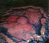 Chromoendoskopie