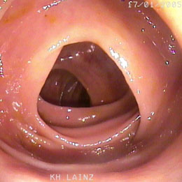 Colon Transversum