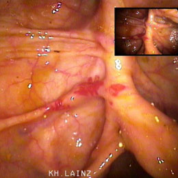 Gefässmalformationen im Dickdarm (Angiodysplasien)1