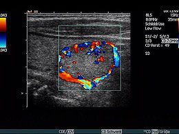 Schilddrüsenknoten Durchblutung