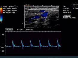 Carotisdoppler-Signal
